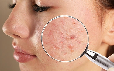 Acne & Pimples